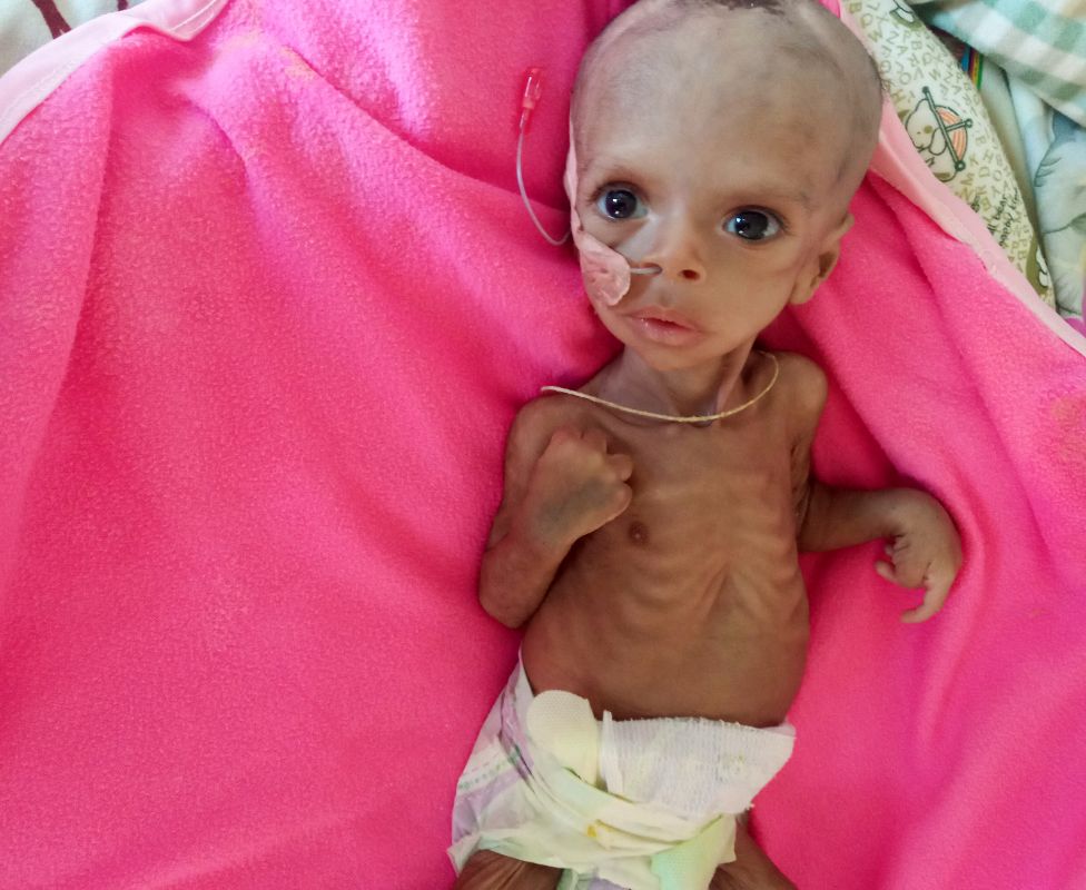 Surafeal Mearig, Satu di Antara Banyak Anak yang Menderita Kekurangan Gizi akibat Konflik Ethiopia